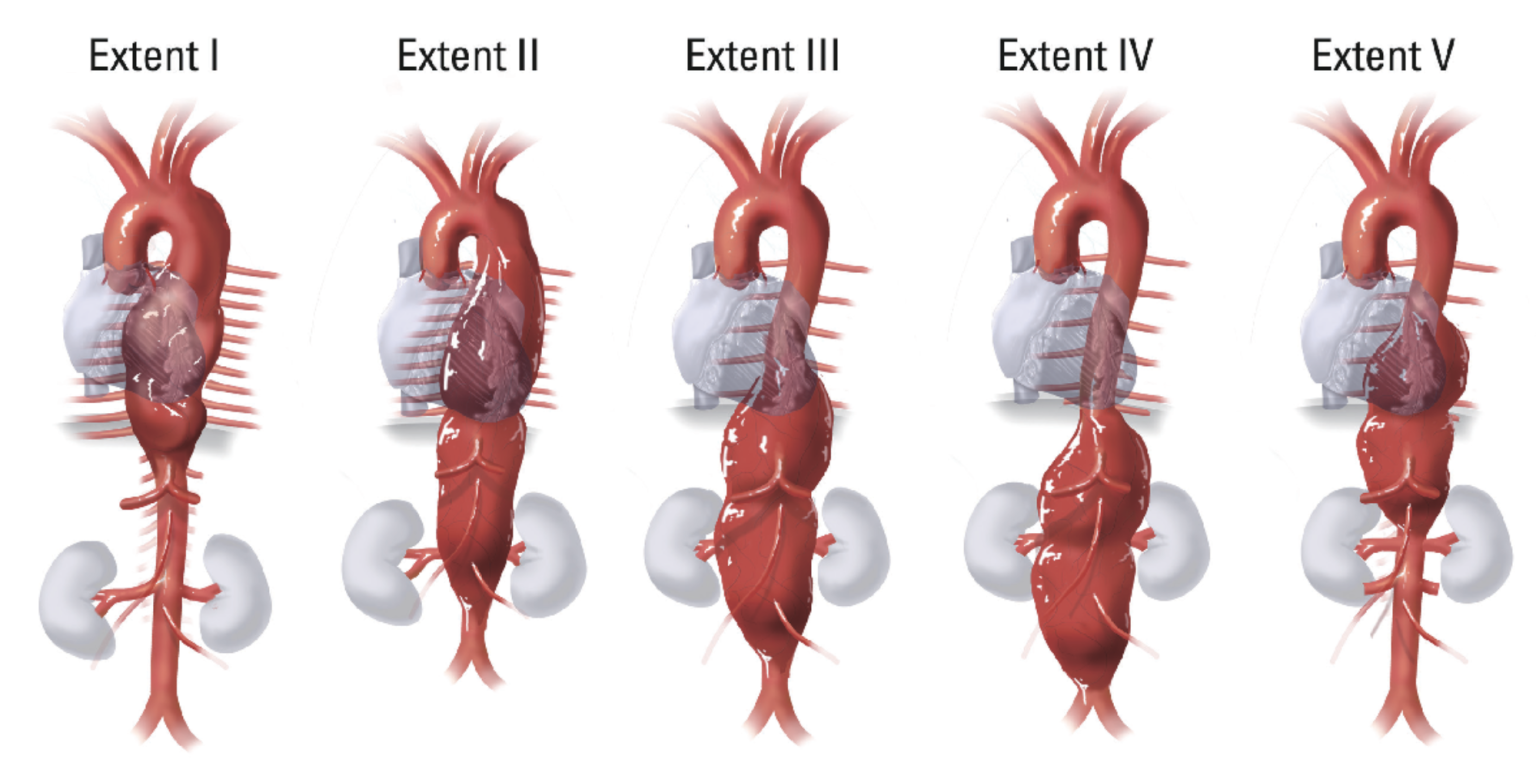Patologia dell’Aorta Toracica – Chirurgia vascolare
